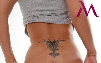Usuwanie tatuażu – jak wygląda, jak długo trwa i czy domowe sposoby działają?